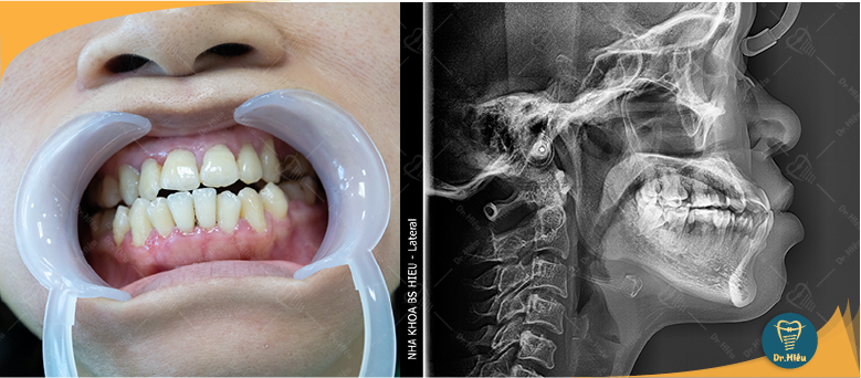 Mô phỏng chỉnh nha răng móm