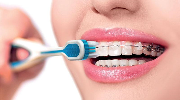 Niềng răng bị hôi miệng? Nguyên nhân và cách khắc phục