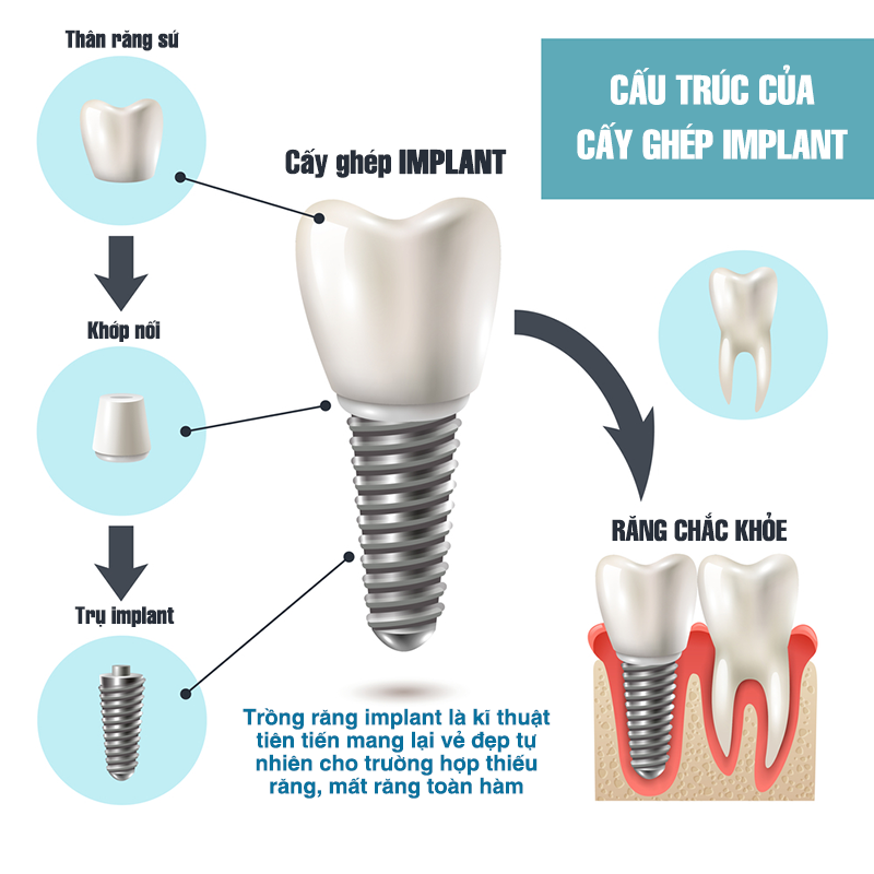 Cấy ghép implant là gì? Những yếu tố ảnh hưởng đến quá trình trồng răng implant 6 cau tao thanh phan cua tru implant hoan chinh