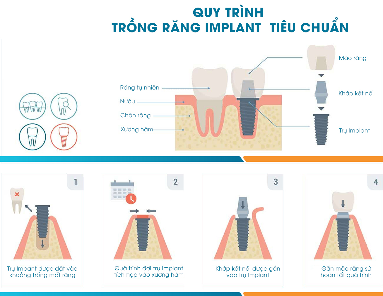 Quy trình cấy implant