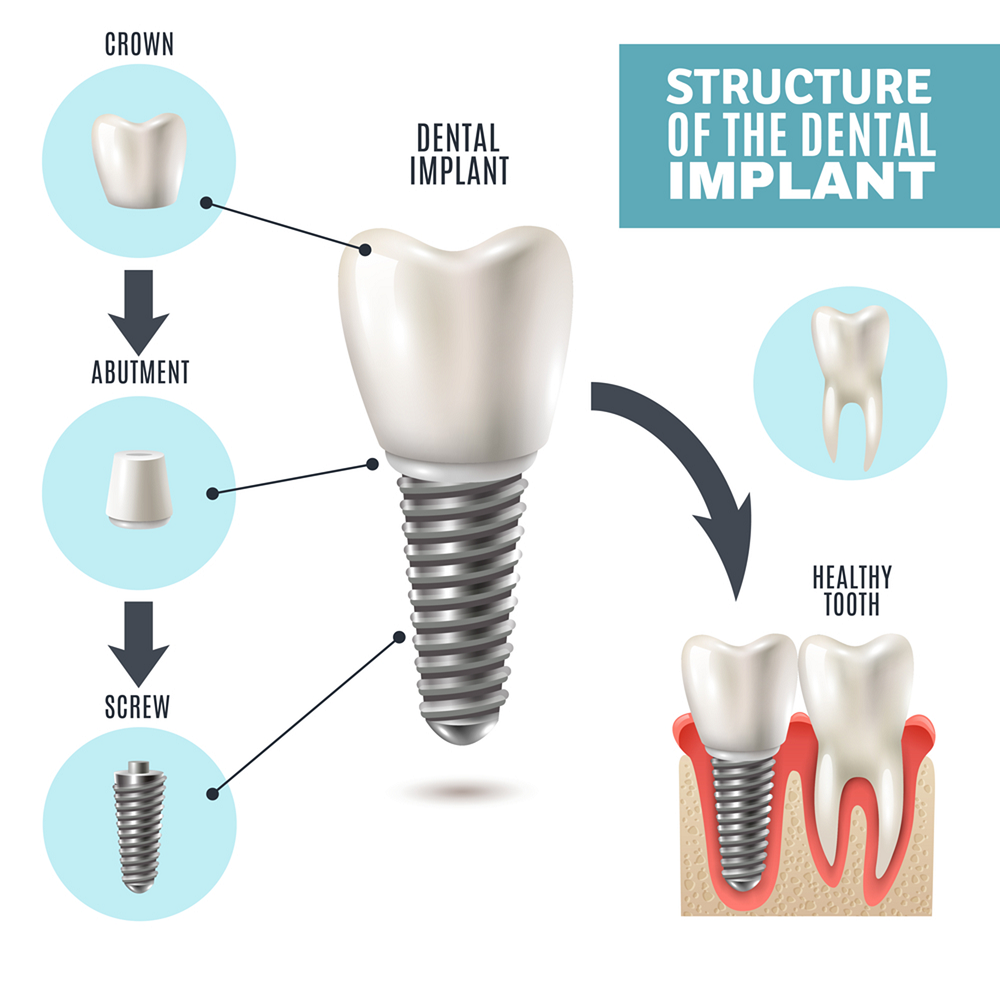 Rủi ro implant