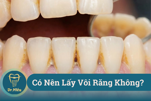 co nen lay voi rang khong