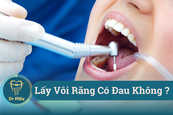 lay voi rang co dau khong