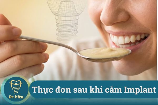 thuc don sau khi cam implant