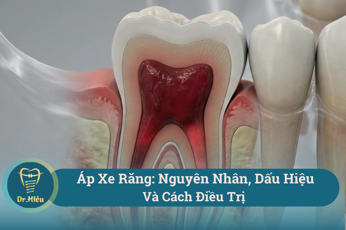 Ap Xe Rang Nguyen Nhan Dau Hieu Va Cach Dieu Tri