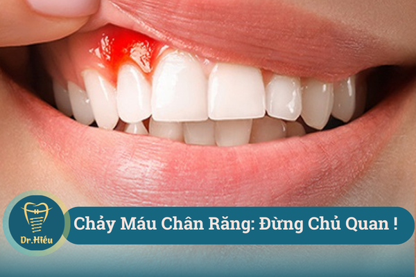 chay mau chan rang