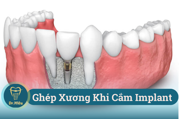 ghep xuong khi cam implant nha khoa bac si hieu