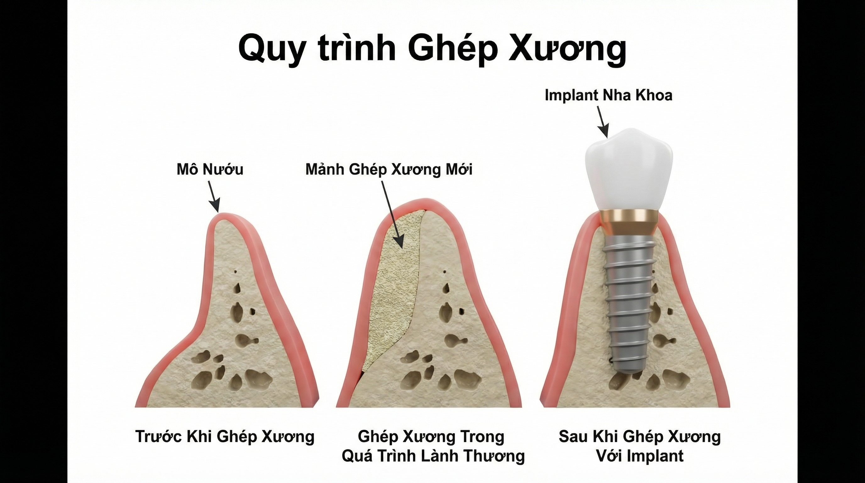 quy trinh ghep xuong khi cam implant