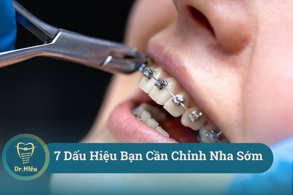 7 dau hieu can chinh nha som