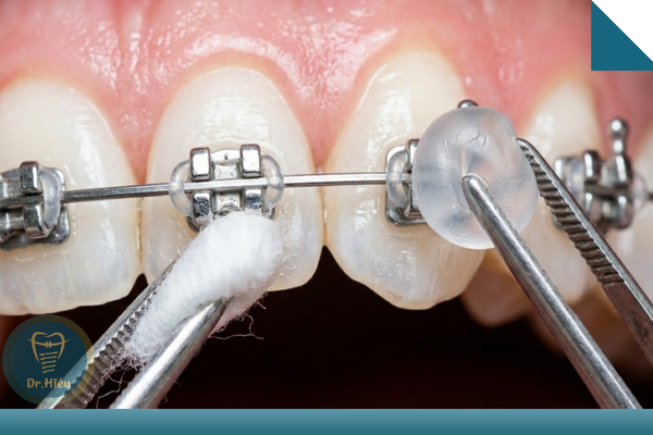 Cách Xử Lý Khi Dây Cung Mắc Cài Đâm Vào Má 15 cach dung sap chinh nha