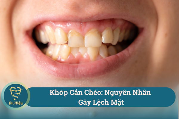 khop can cheo nguyen nhan gay lech mat